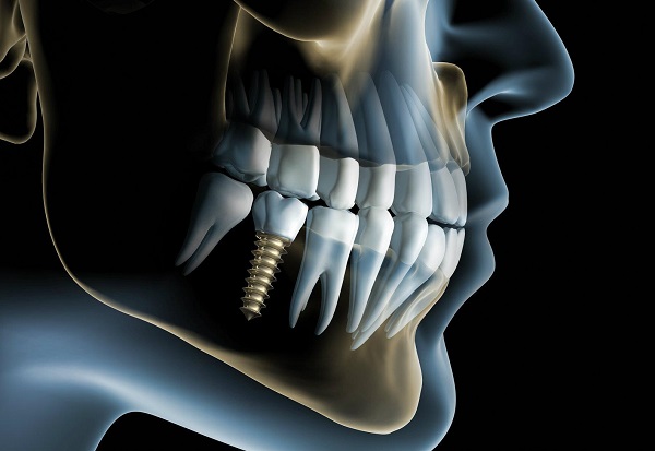 affordable-dental-implants