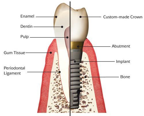 implants-dental